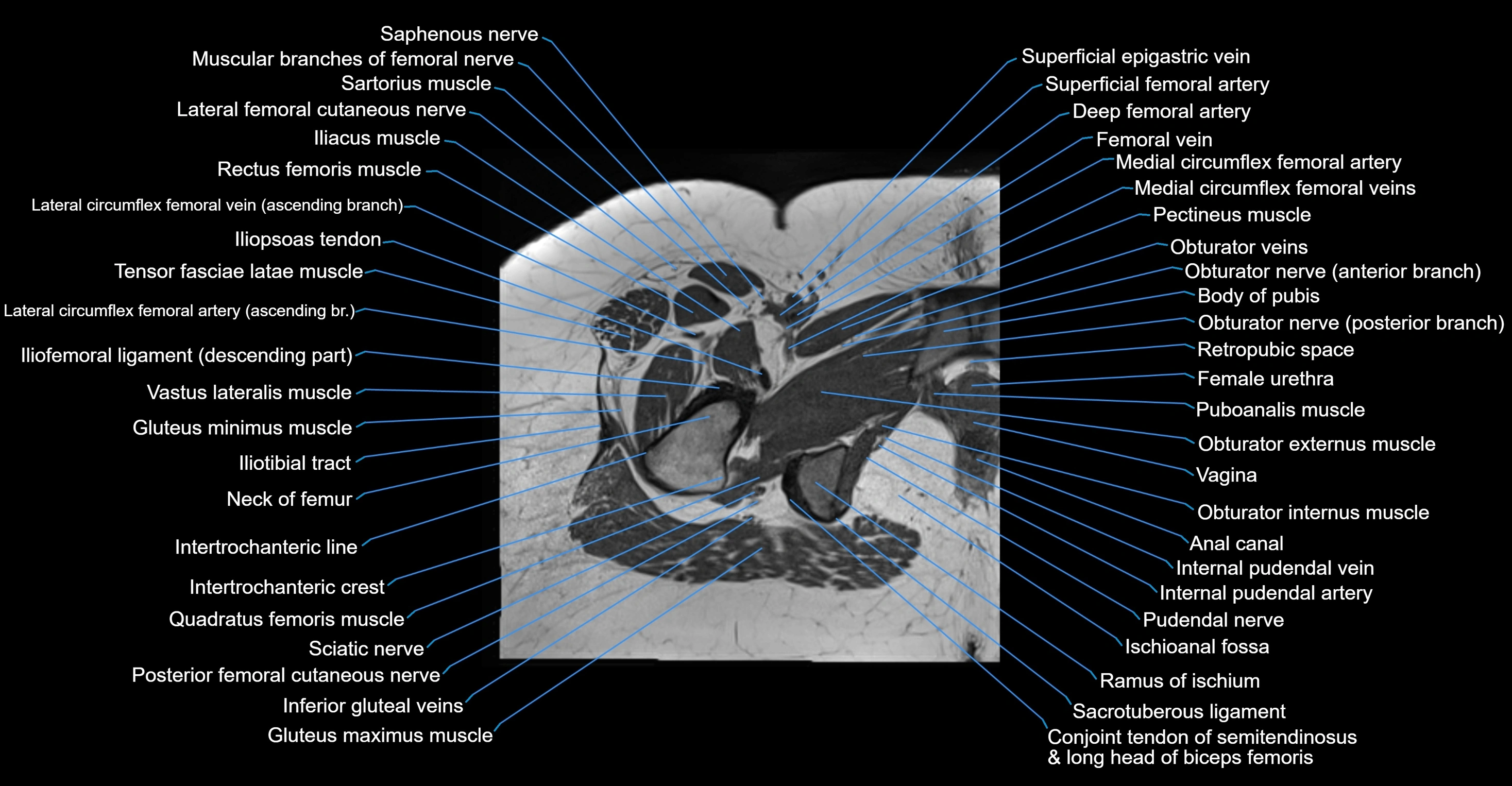 MRI hip axial cross sectional anatomy 3T 3D  radiology  anatomy image-img-00001-00055.webp